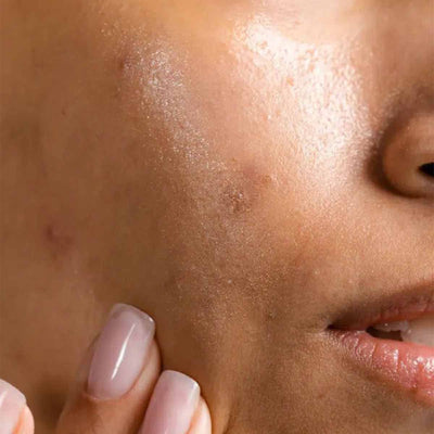 Dark Spots & Marks