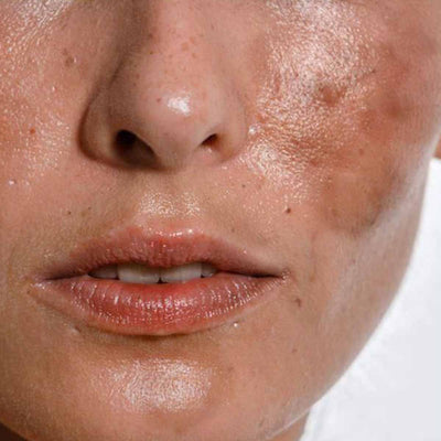Acne & Breakouts